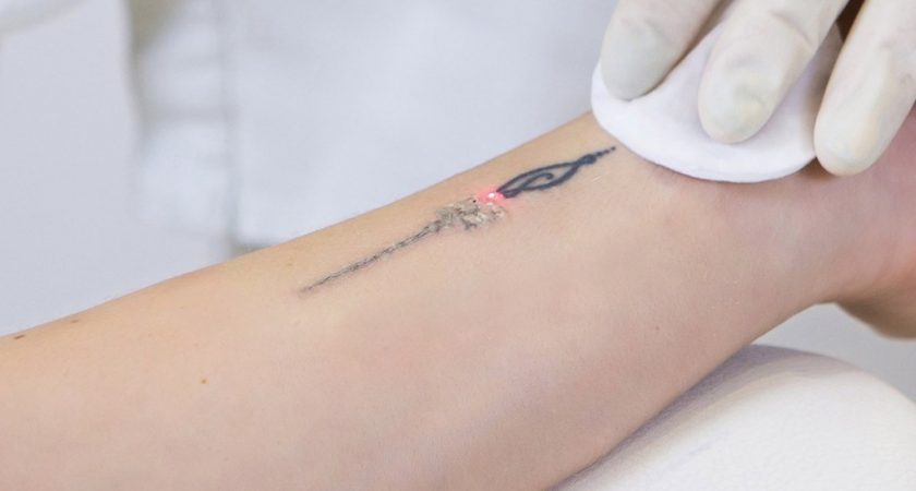 Is The Modern Process Of Tattoo Removal Painful Or Not